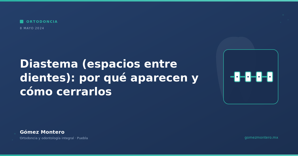 Diastema (espacios entre dientes): por qué aparecen y cómo cerrarlos